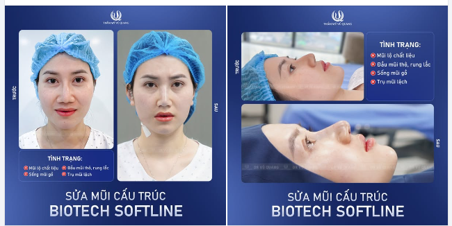 Mũi lệch, lộ chất liệu sau thẩm mỹ