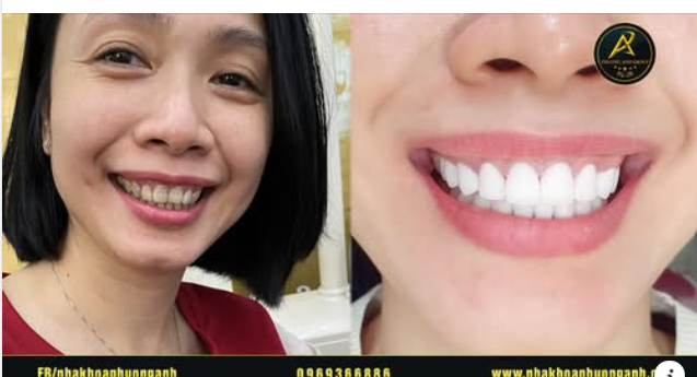 Smile Design – Nụ cười hoàn hảo với giải pháp công nghệ mới