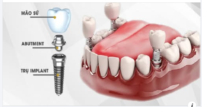 CHĂM SÓC RĂNG SAU KHI CẤY IMPLANT