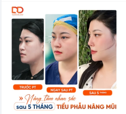 KHÁCH HÀNG THAY ĐỔI DIỆN MẠO SAU 5 THÁNG NÂNG MŨI