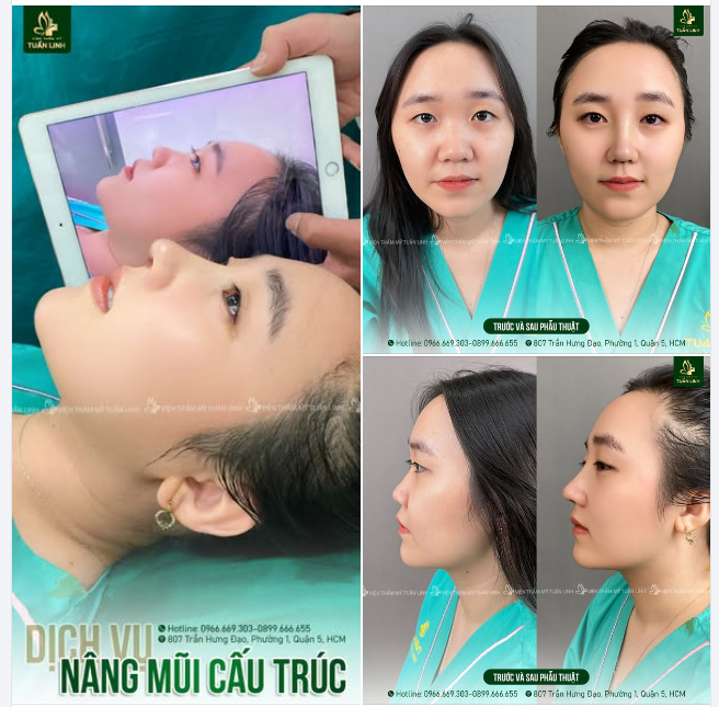 Nâng mũi cấu trúc - Khắc phục toàn diện khuyết điểm mũi - Lên dáng mũi mới đẹp hài hòa, cân đối, bền chắc dài lâu.