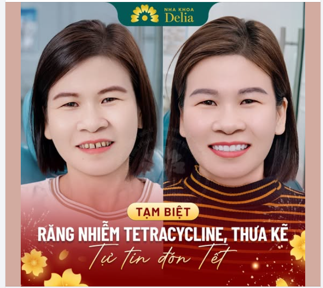 LÀM RĂNG SỨ XÓA SỔ TÌNH TRẠNG NHIỄM TETRACYCLINE, THƯA KẼ TỰ TIN CHÀO NĂM ẤT TỴ