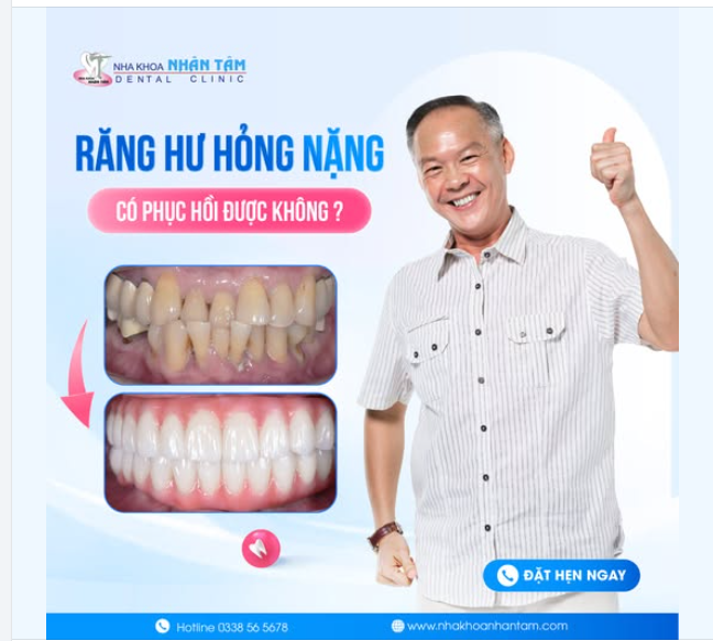 Răng Hư Hỏng Nặng Có Phục Hồi Được Không?