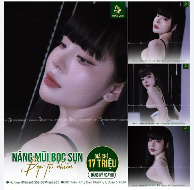 Mũi bọc sụn 17Triệu ( trọn gói) - Đẹp tự nhiên, hài hòa mà vẫn thanh tú, sắc nét!!