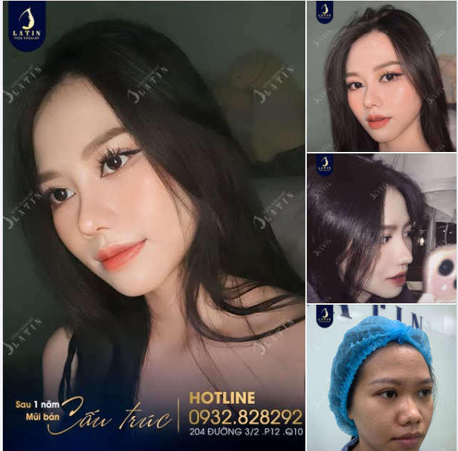 Sau 1 năm nâng mũi, em có gì...  Đó chính là sự tự tin cùng nhan sắc xinh đẹp này