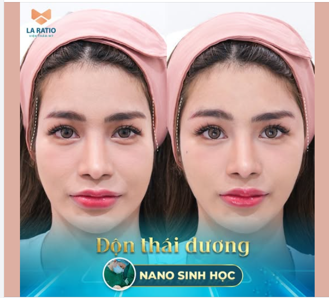 Độn thái dương nano sinh học tại La Ratio  Đẹp tự nhiên - Duy trì vĩnh viễn