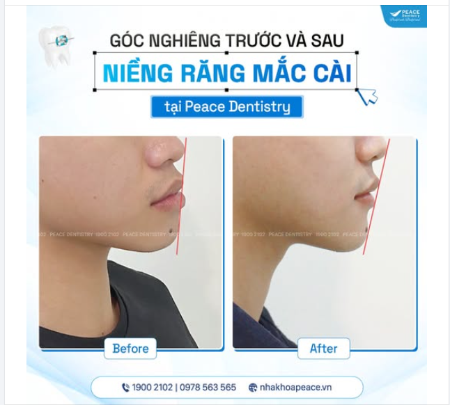 GÓC NGHIÊNG HOÀN HẢO TỰ NHIÊN – BÍ QUYẾT TỪ NIỀNG RĂNG TẠI PEACE DENTISTRY!