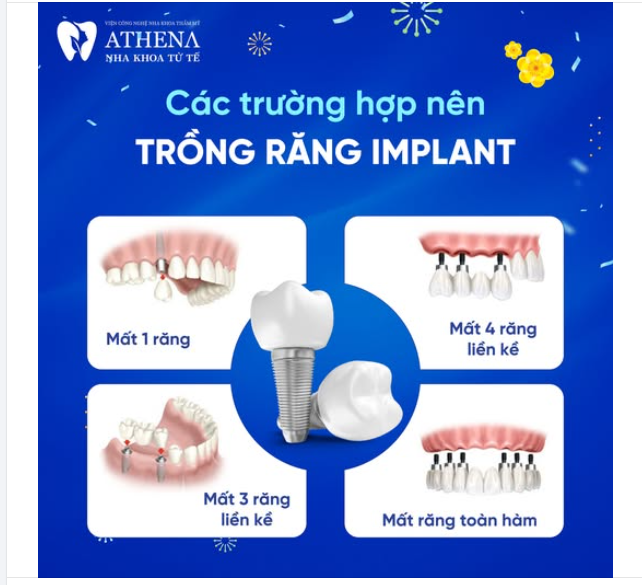 Bạn có biết? Trồng răng Implant là giải pháp hàng đầu giúp phục hồi chức năng ăn nhai và mang lại nụ cười tự tin cho những trường hợp mất răng.