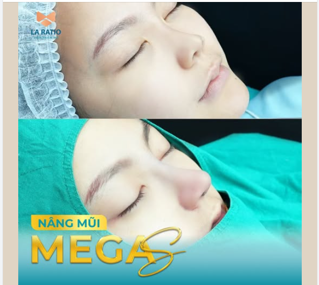 Nâng mũi Mega S - Kết quả hoàn mỹ cho khách hàng muốn đầu mũi bay