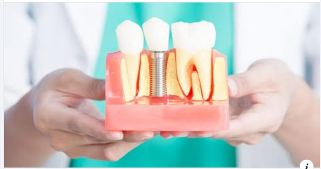 9 lợi ích của việc cấy ghép Implant
