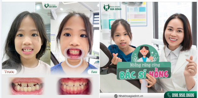 TIỀN CHỈNH NHA CHO CON - MÓN QUÀ TỪ CHA MẸ