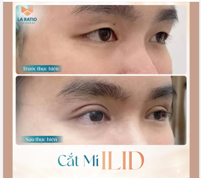 CẮT MÍ CÓ DÀNH CHO NAM GIỚI