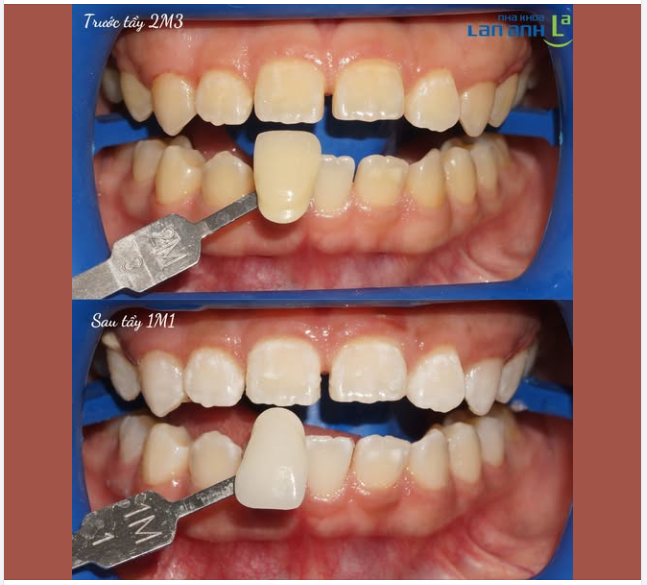 Bạn có tìm hiểu về tẩy trắng răng chưa?  Nếu thực hiện đúng, thì sẽ đạt kết quả tốt, và an toàn cho răng ạ!