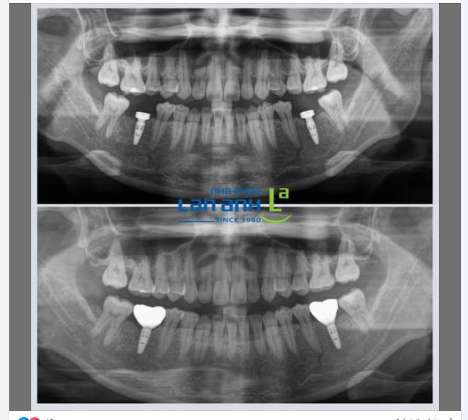 Đặt Implant tại nha khoa Lan Anh luôn được khảo sát và kiểm tra lại kỹ lưỡng bằng x-quang, để chắc chắn là Implant được đặt tốt, đúng vị trí như kế hoạch ạ.