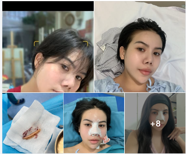 8 năm 2 lần cho 1 hành trình tìm lại chiếc mũi mong ước!