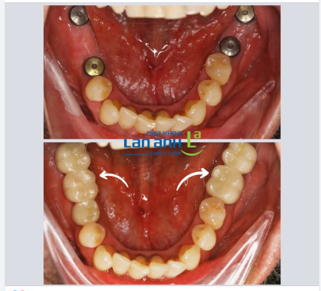 Đặt Implant tốt, rồi phải làm răng sứ lên trên thật tốt nữa, thì kết quả mới tốt ạ!