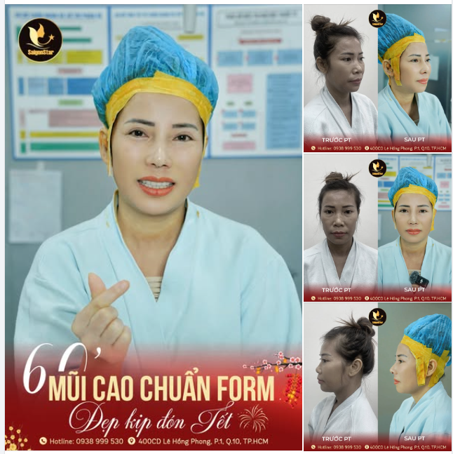 CÙNG BÁC SĨ HOẠT – NÂNG MŨI XINH TỰ TIN ĐÓN TẾT