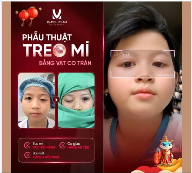 Phẫu thuật sụp mi bẩm sinh - Mở rộng tầm nhìn cho đôi mắt!