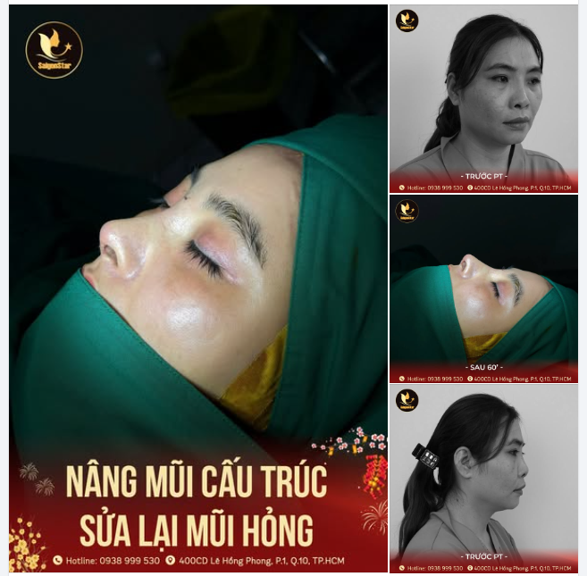 SỬA LẠI MŨI HỎNG - TỰ TIN ĐÓN TẾT