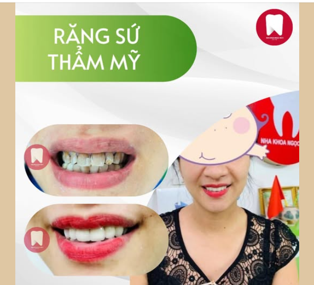 RĂNG NHIỄM KHÁNG SINH TETRACYCLINE