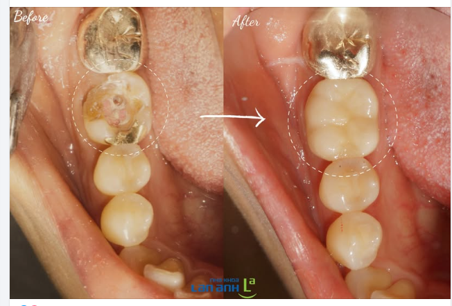 Khách Hàn Quốc ăn nhai chẳng may bị bể Onlay vàng luôn rồi ạ.