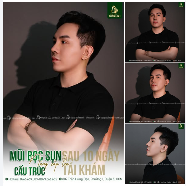 Hình ảnh thực tế từ khách hàng sau 10 ngày nâng cấp mũi cấu trúc ( mũi cũ bọc sụn thông thường) đẹp xuất sắc!!