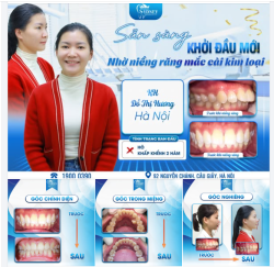 SẴN SÀNG KHỞI ĐẦU MỚI NHỜ NIỀNG RĂNG MẮC CÀI KIM LOẠI