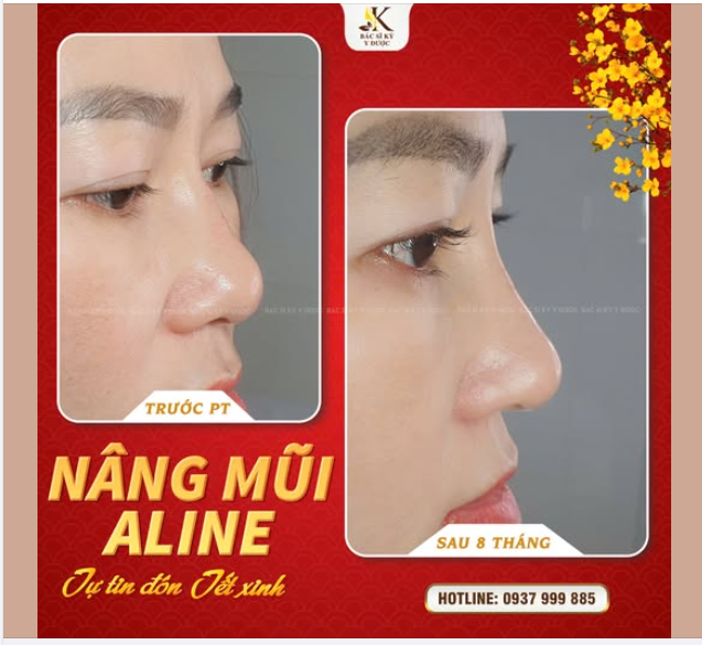 Đón Tết xinh, tự tin toả sáng với mũi ALINE: