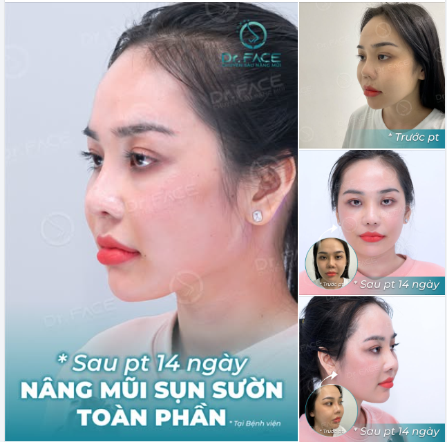 "Em từng TỰ TI LẮM vì chiếc mũi CO RÚT"