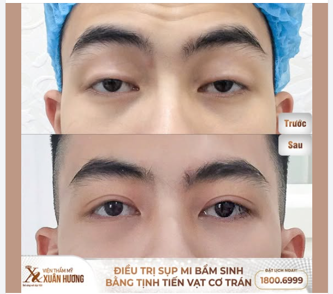 ĐIỀU TRỊ SỤP MÍ BẰNG TỊNH TIẾN VẠT CƠ TRÁN 