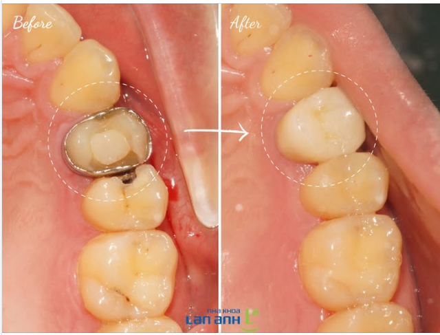 Khách ở nước ngoài, được đặt khung để bảo vệ răng không bị bể vỡ lớn vì răng đã chữa tủy và có nguy cơ cao.