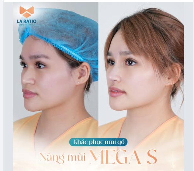 KHẮC PHỤC MŨI GỒ - KHÔNG CẦN MÀI NHỜ CÔNG NGHỆ NÂNG MŨI CẤU TRÚC MEGA S