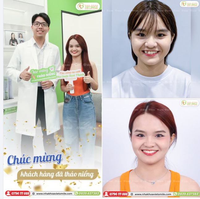 "... NIỀNG XONG THAY ĐỔI NHƯ THÀNH MỘT NGƯỜI KHÁC ..."