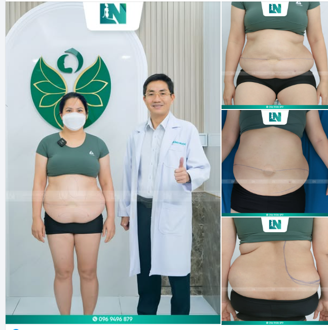 GIẢI CỨU CHIẾC BỤNG PHÌ ĐẠI 116CM