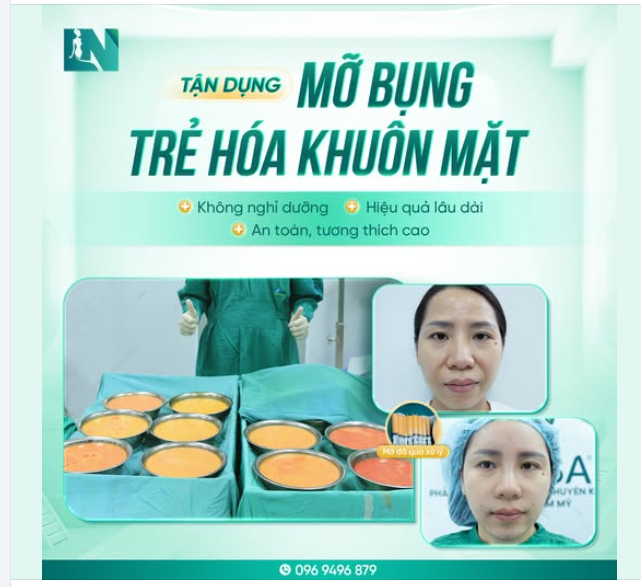 LẤY MỠ THỪA - LÀM ĐẦY KHUÔN MẶT