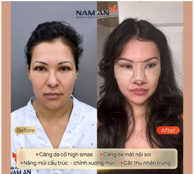 THAY ĐỔI HOÀN HẢO TẠI BỆNH VIỆN THẨM MỸ NAM AN