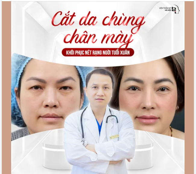 CẮT DA CHÙNG CHÂN MÀY   Đôi mắt trở lại tươi trẻ sau 30 phút 