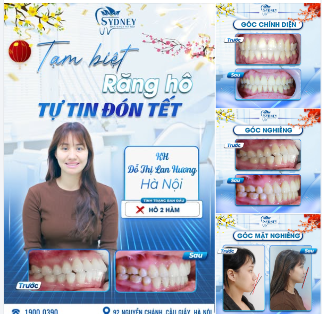 TẠM BIỆT RĂNG HÔ - TỰ TIN ĐÓN TẾT