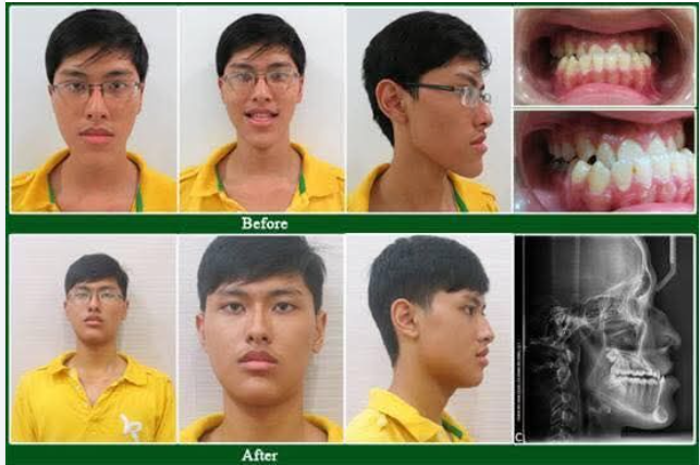 CHẾ ĐỘ ĂN UỐNG DÀNH CHO CÁC "ĐỒNG NIỀNG" VỪA "TỐT NGHIỆP"