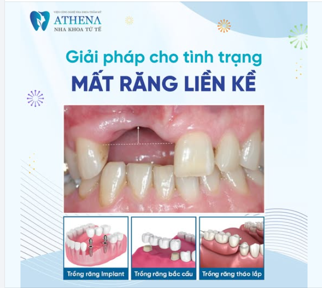 Mất răng liền kề không chỉ ảnh hưởng đến thẩm mỹ mà còn giảm khả năng ăn nhai và gây tiêu xương hàm. Dưới đây là 3 giải pháp phổ biến: