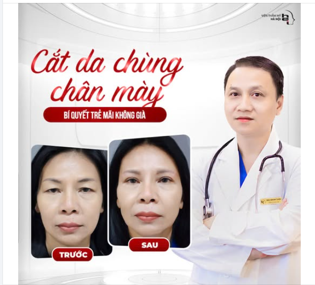 Vì sao phải thực hiện cắt da chùng chân mày