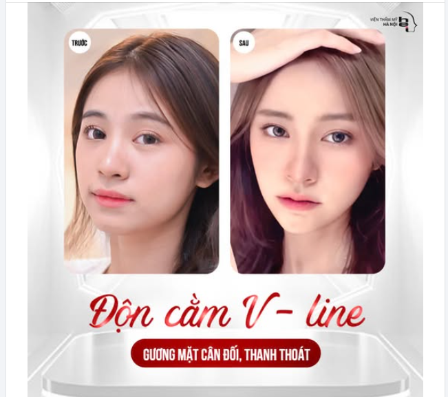 ĐỘN CẰM VLINE   gương mặt hài hoà với các đường nét thanh tú 