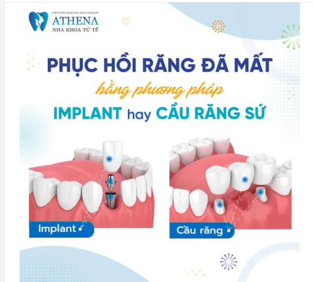 Mất răng không chỉ ảnh hưởng đến thẩm mỹ mà còn gây khó khăn trong ăn uống và sức khỏe răng miệng.
