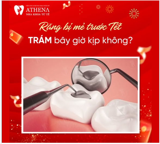 Nếu bạn không may bị mẻ răng ngay trước Tết, đừng quá lo lắng! Việc trám răng là một giải pháp nhanh chóng và hiệu quả để khắc phục tình trạng này.