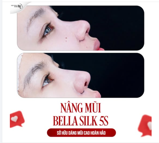 NÂNG MŨI BELLA SILK 5S  MŨI CAO XINH đón năm mới TÀI LỘC 
