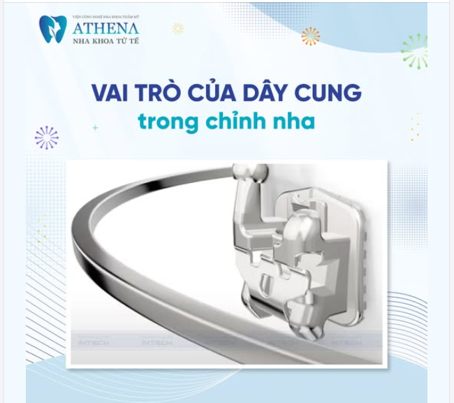 Trong quá trình niềng răng, dây cung (archwire) là một thành phần quan trọng không thể thiếu.