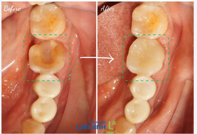 Răng bị mẻ và bể lớn, được tái tạo lại bằng Onlay sứ, nhìn như răng thật ạ!