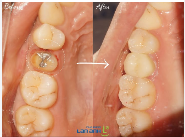 Nếu không có hình trước khi gắn răng, chưa chắc bạn sẽ biết được răng nào là răng sứ!