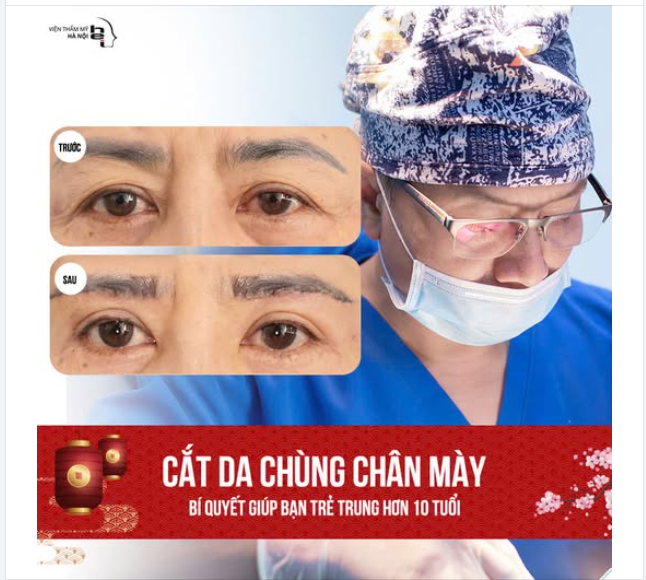 Cắt da chùng chân mày KHÔNG KHÂU DA   Trẻ ra 10 tuổi - Kéo dài Phúc khí
