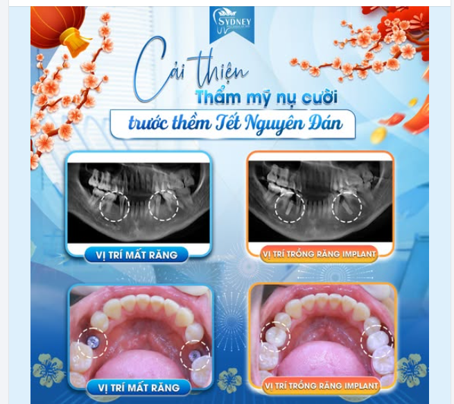 CẢI THIỆN THẨM MỸ NỤ CƯỜI TRƯỚC THỀM TẾT NGUYÊN ĐÁN